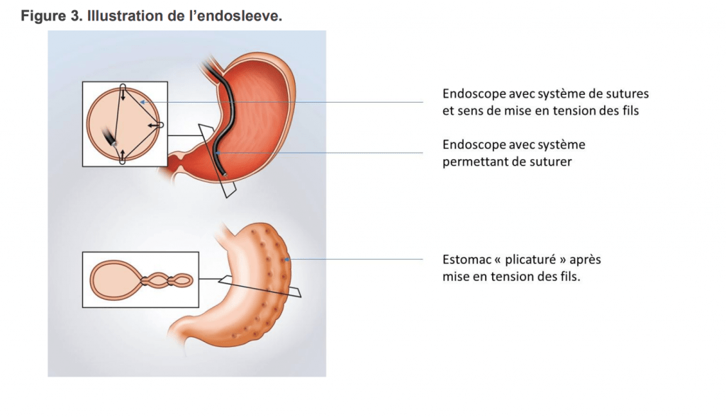 endosleeve