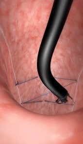 fibroscopie-gastrique-endosleeve