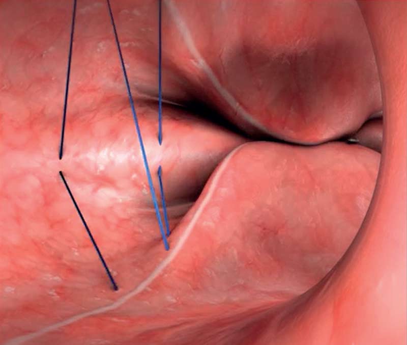 Sutures - Sleeve gastroplastie endoscopique