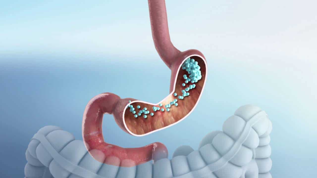 Endoscopic gastroplasty sleeve - A new non-surgical management technique